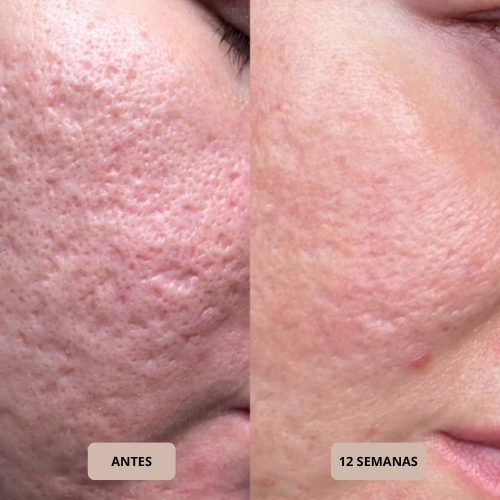 SkinRestore™ Stick – Reparación Avanzada para Cicatrices y Piel con Acné.