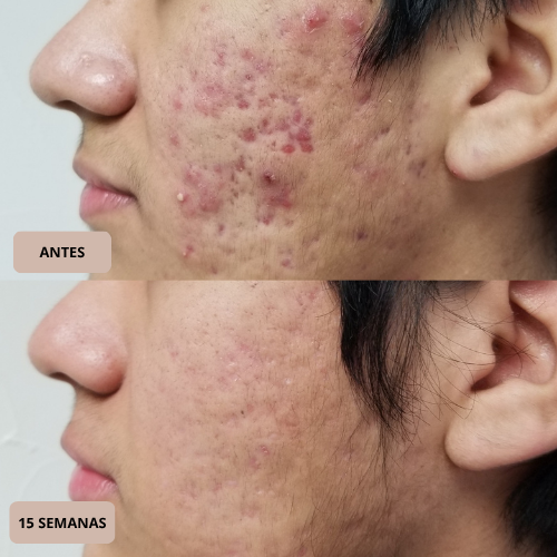 SkinRestore™ Stick – Reparación Avanzada para Cicatrices y Piel con Acné.