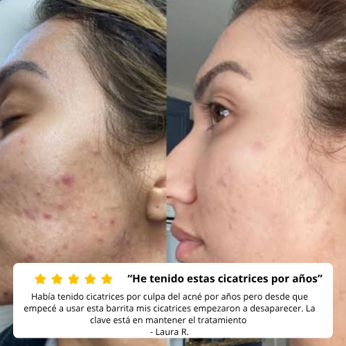 SkinRestore™ Stick – Reparación Avanzada para Cicatrices y Piel con Acné.